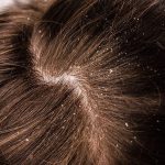 Know all about dandruff Scalp treatment Singapore