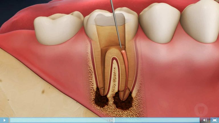 Regain Confidence: Transform Your Smile with Root Canal Treatment in Singapore