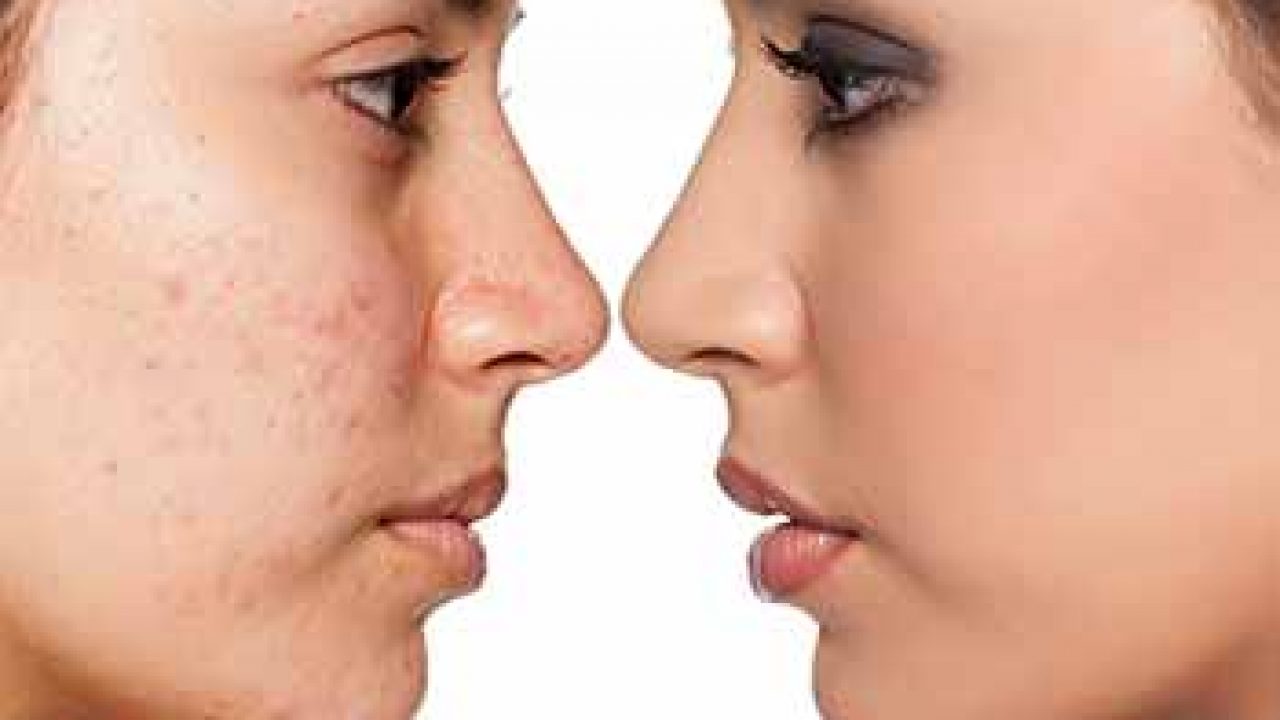 laser treatment for acne scars