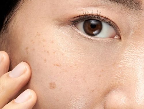 Understanding Pigmentation: Causes and Treatment Options