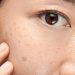 Understanding Pigmentation: Causes and Treatment Options