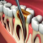 root canal treatment singapore