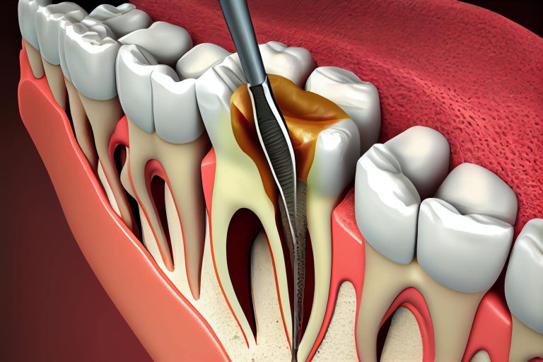 root canal treatment singapore